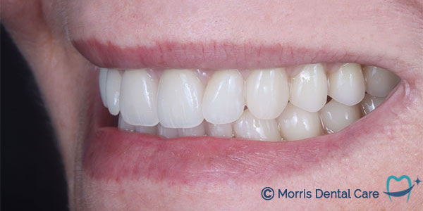 Natural looking full dentures achieving excellent suction.